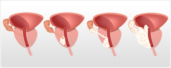 infectii vezica urinara simptome tratament naturist pentru cancer prostata